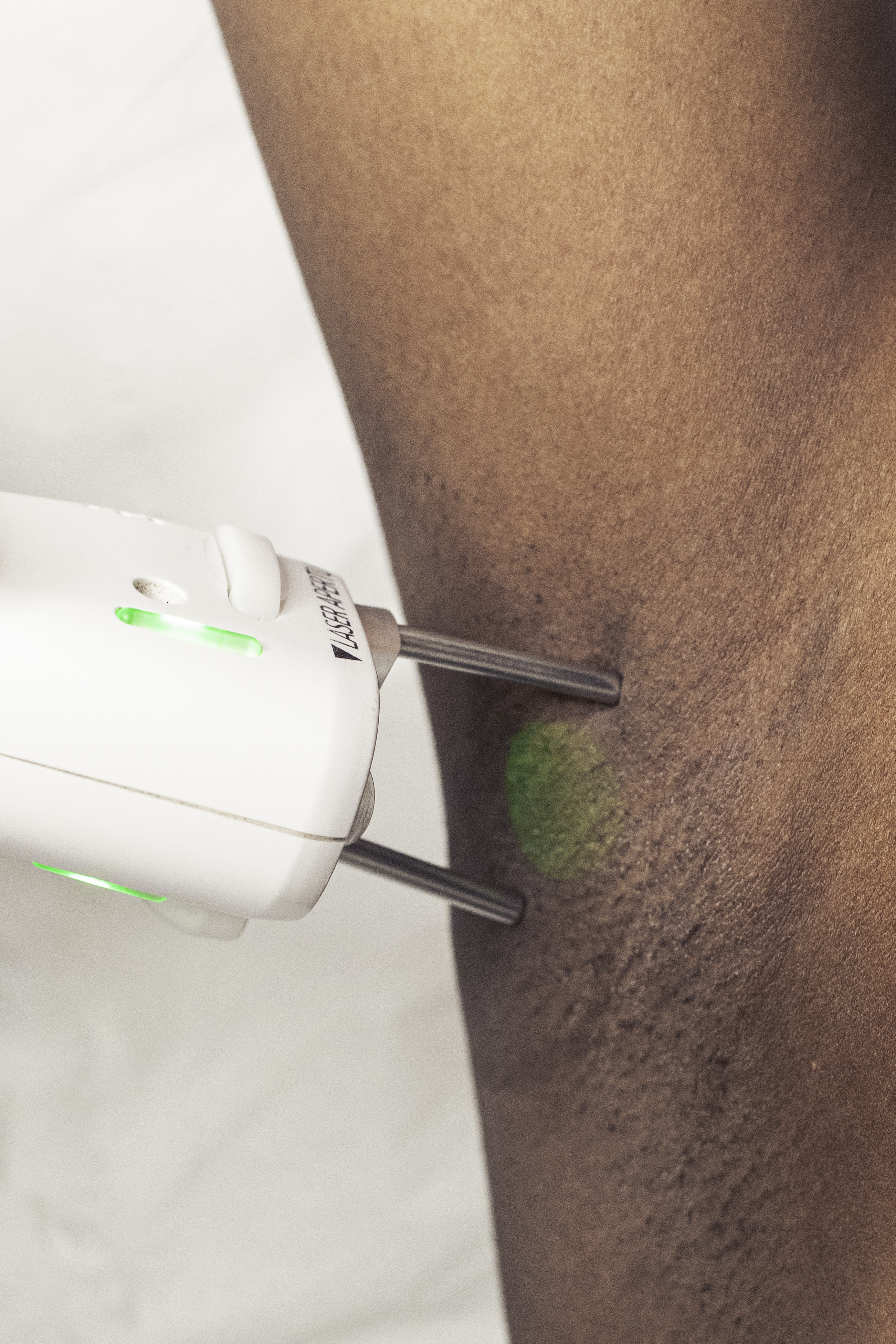 épilation laser peau noire Paris